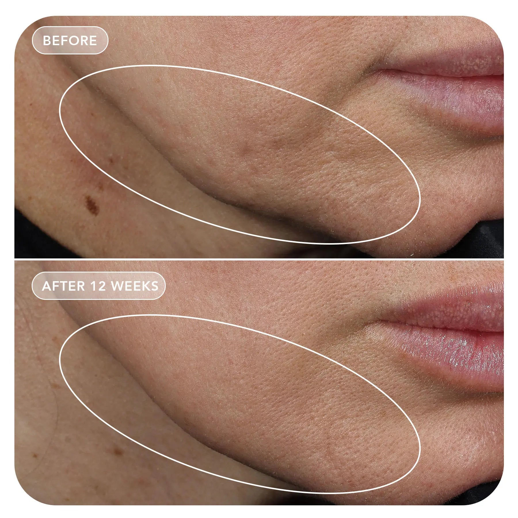 VOL.U.LIFT™ GLP-1 4D Skin Rebound Complex