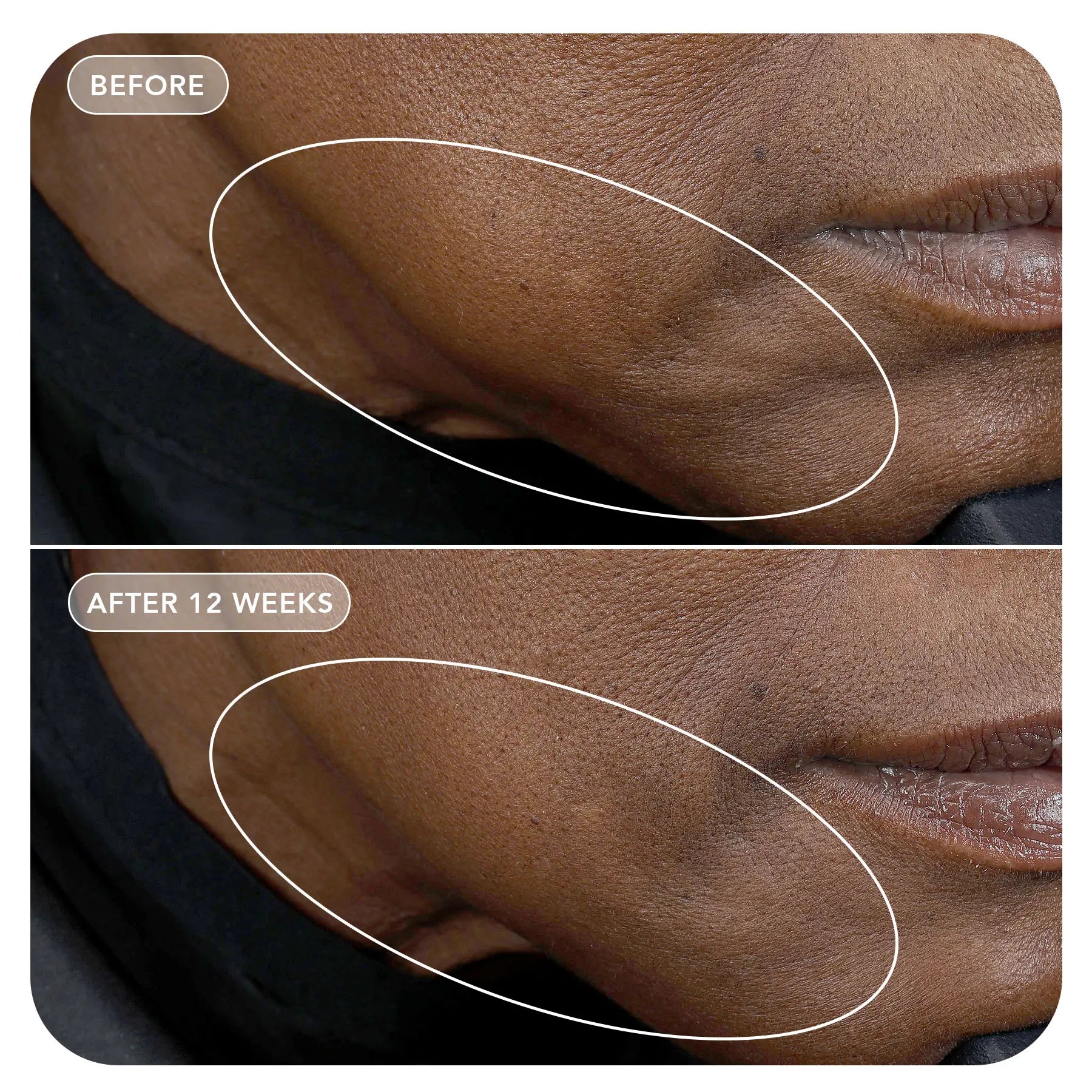 VOL.U.LIFT™ GLP-1 4D Skin Rebound Complex
